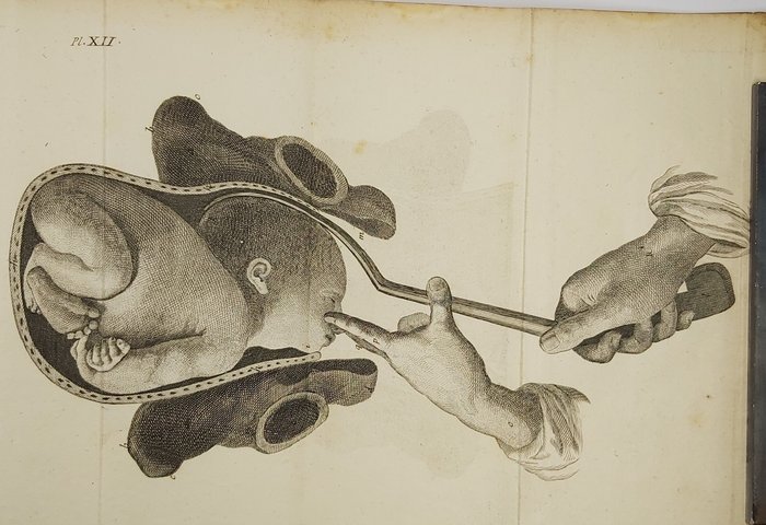 Jean-Louis Baudelocque - L'Art des accouchemens - 1789