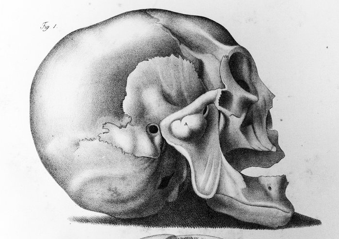 D. J. Cruveilhier. - Atlante generale della anatomia patologica del corpo umano - 1843