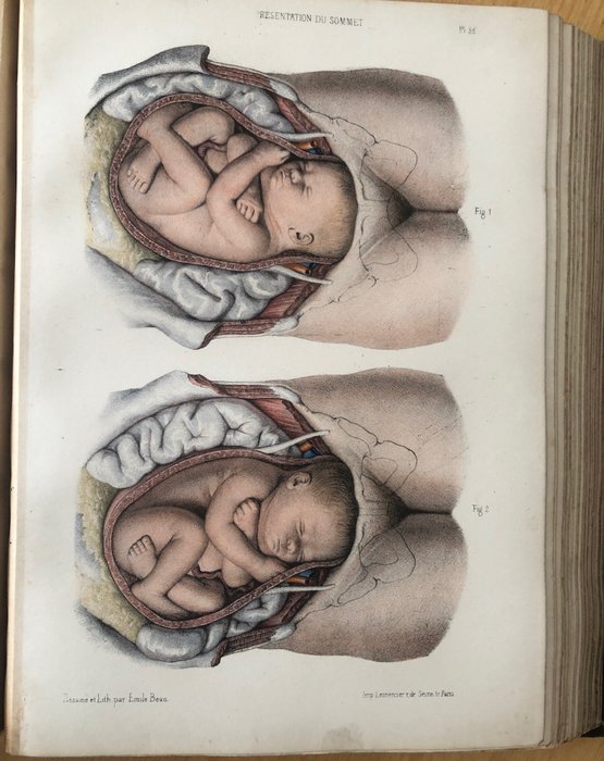 A. Lenoir - M. Sée - S. Tarnier - Atlas de l'Art des Accouchements - 1871