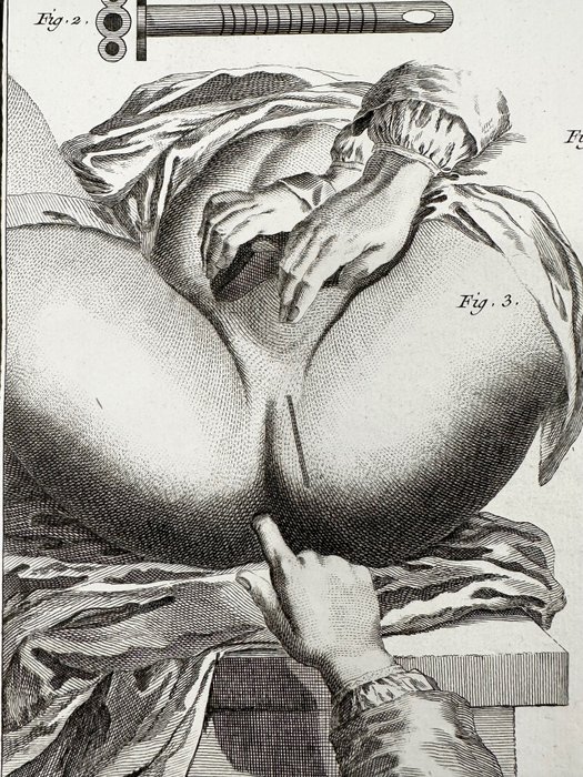 Robert Bénard (XVIII) - Chirurgie, Bistouri, Cannulle, le Périnée et muscles du périnée